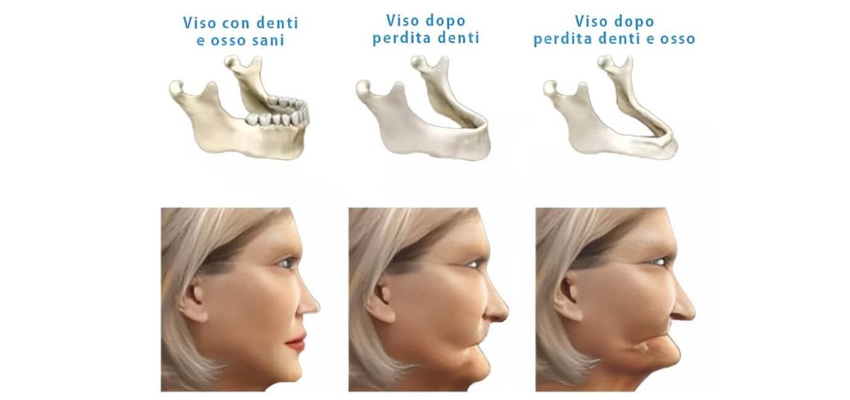 Conseguenze della perdita dei denti