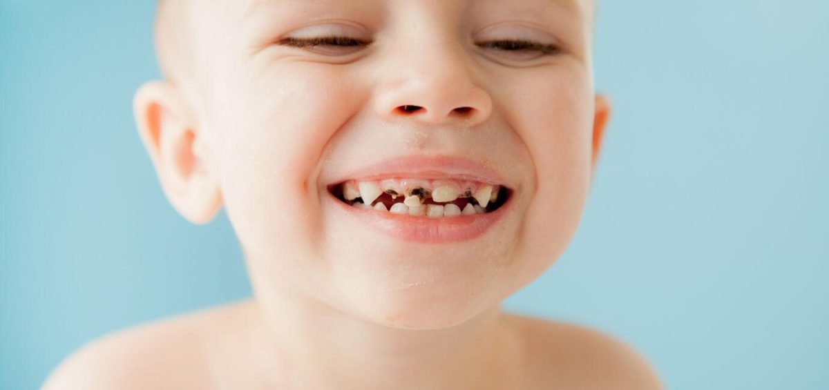 Carie-nei-bambini-cause-trattamenti-prevenzione