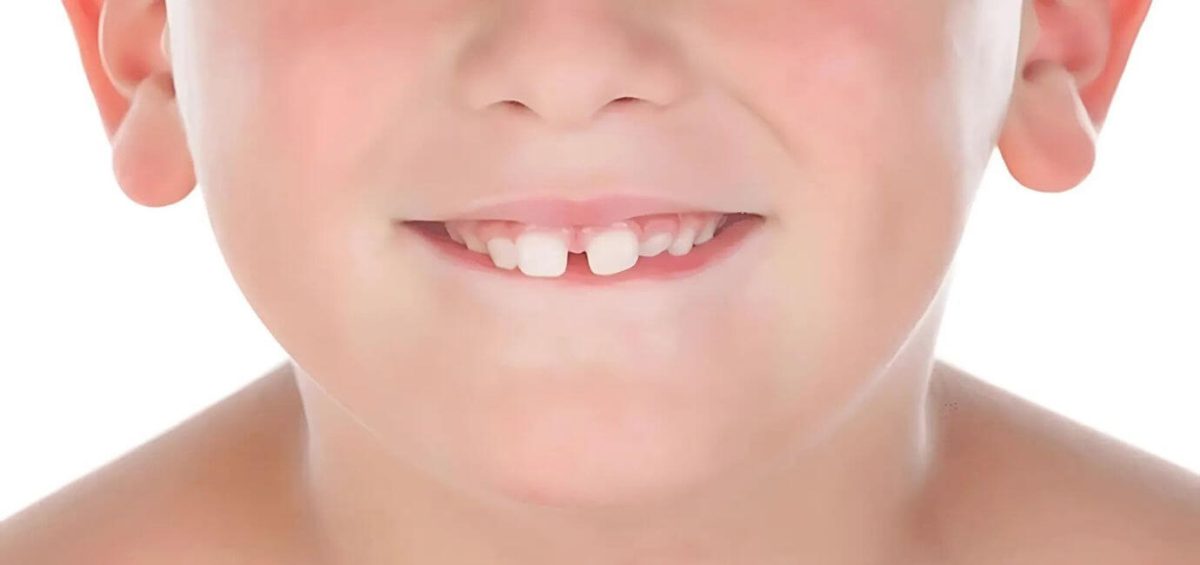 Diastema nei bambini