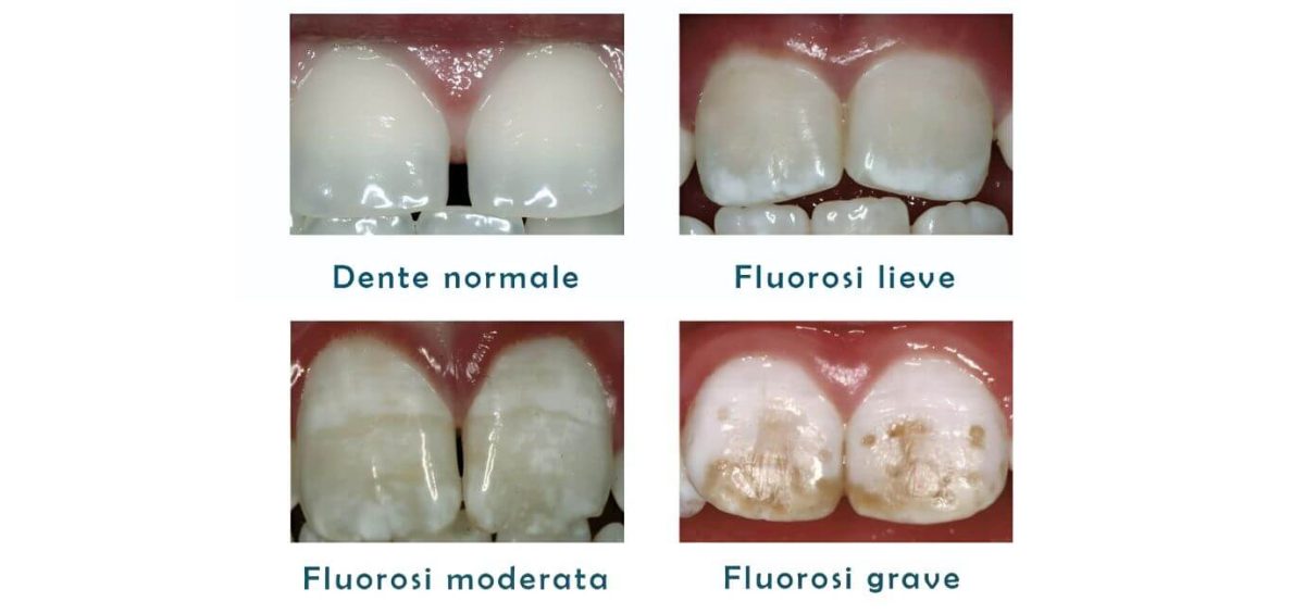 Fluorosi dentale nei bambini