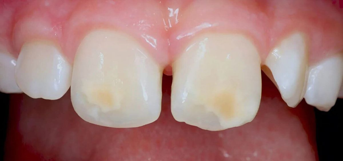 Macchie dentali nei bambini – MIH