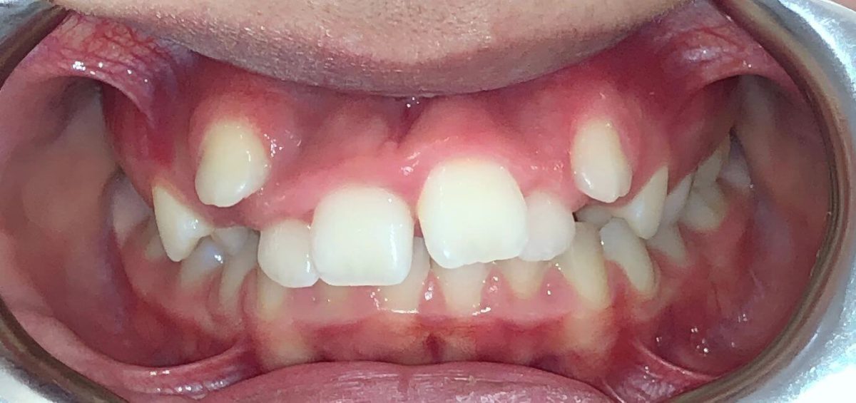 Malposizionamento e disallineamento dentale nei bambini