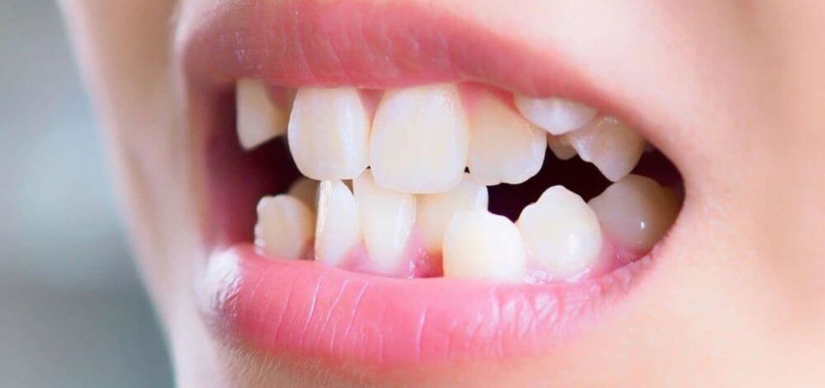 malocclusione dentale bambini