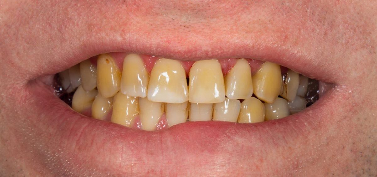 discromie dentali