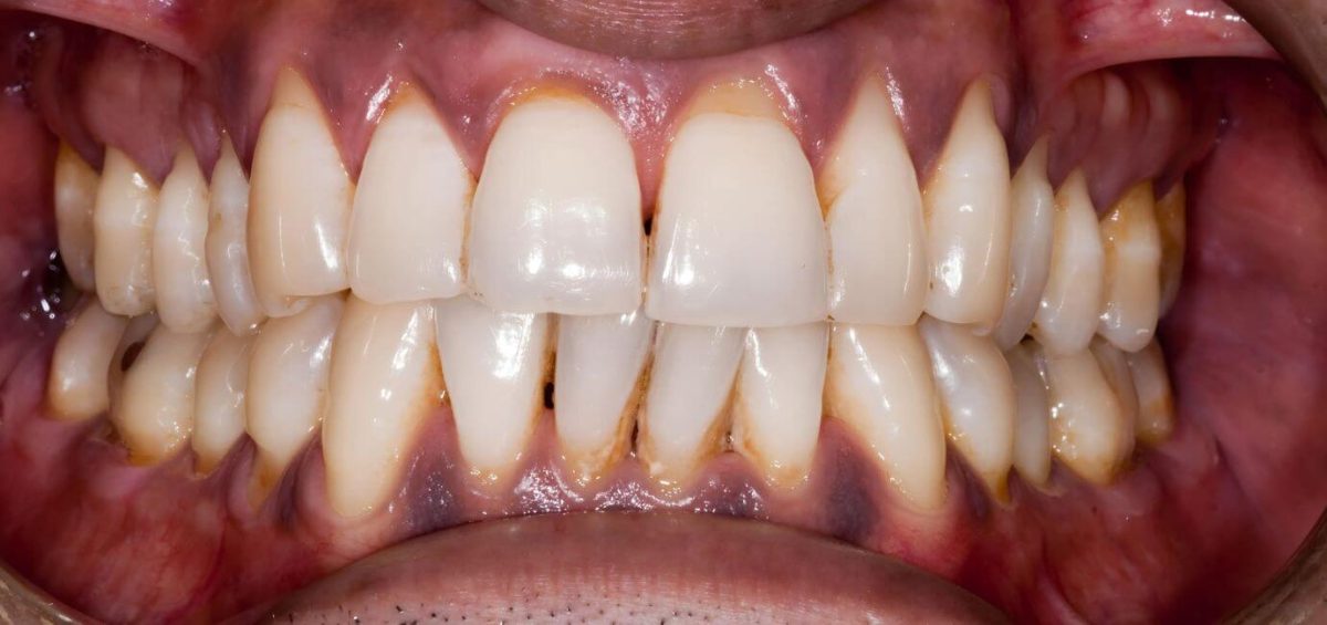macchie fumo denti