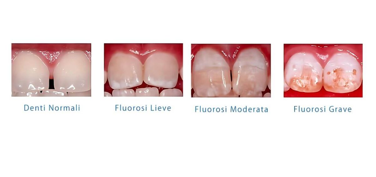 Sintomi-Fluorosi-dentale