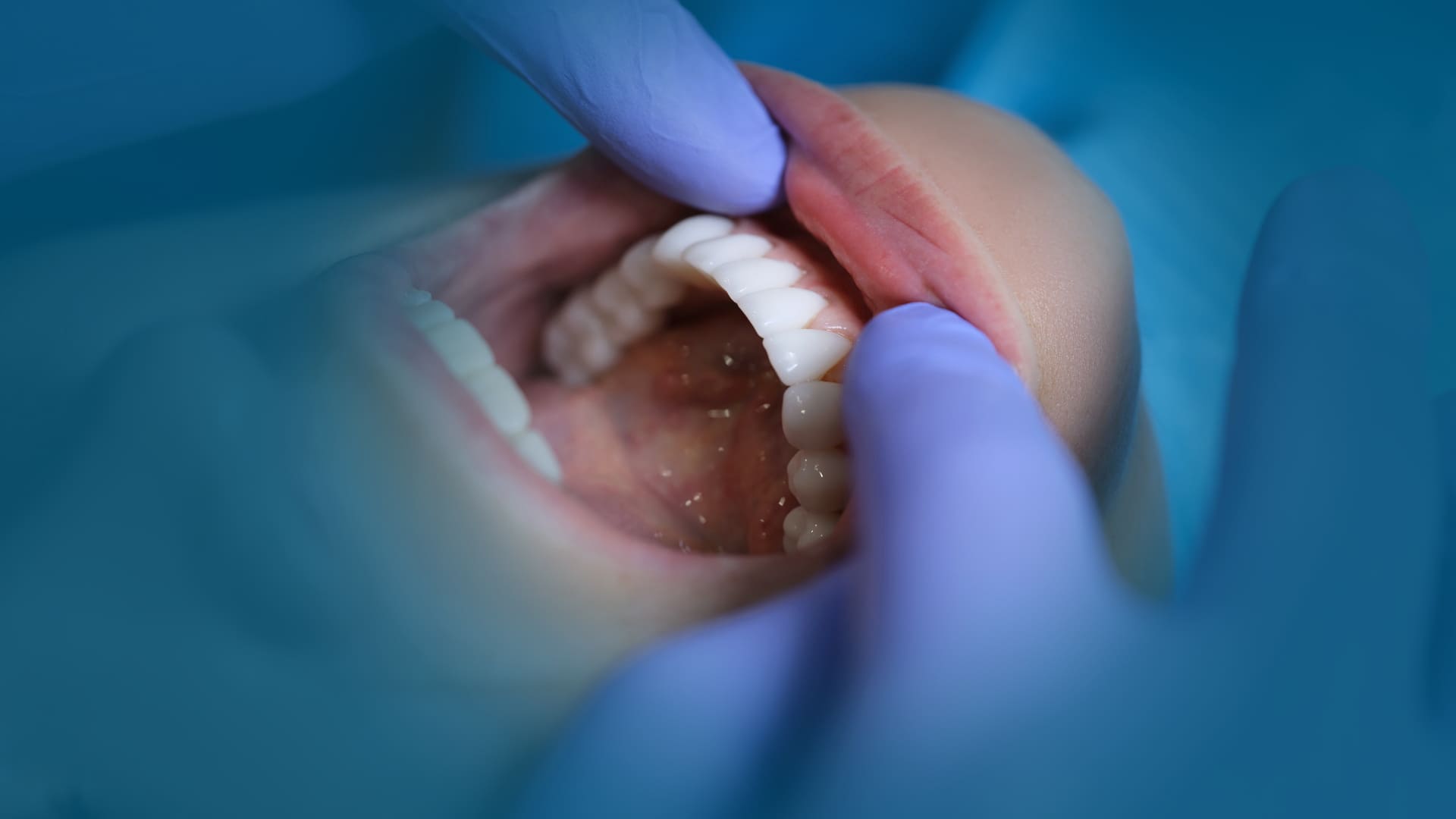 Faccette dentali
