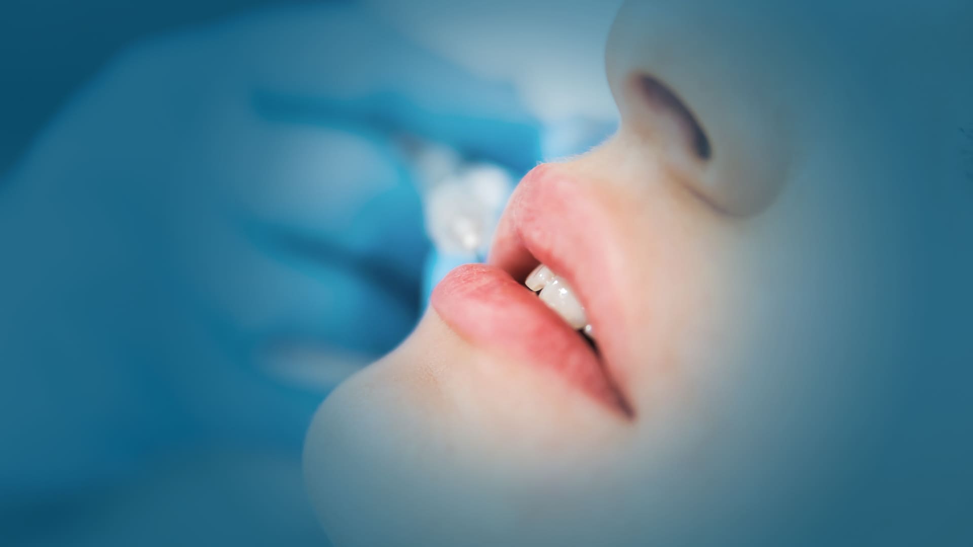 Filler labbra