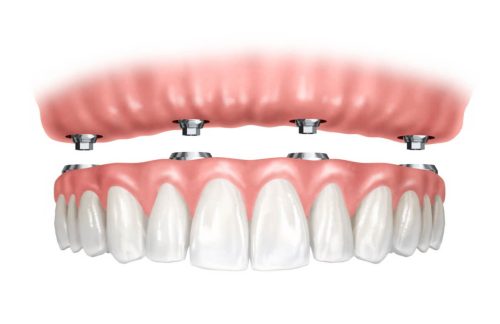 Protesi-mobili-overdenture