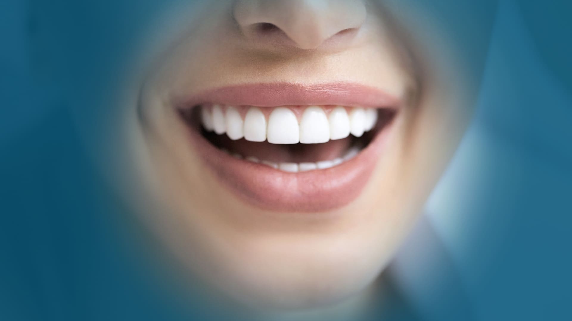 Sbiancamento dentale