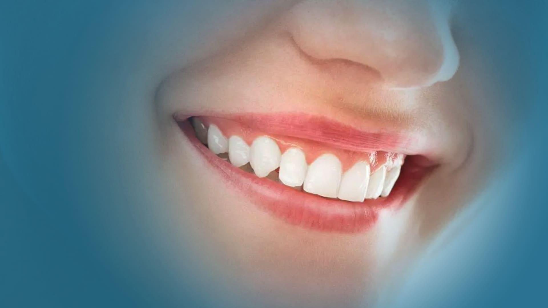 Correzione del sorriso gengivale