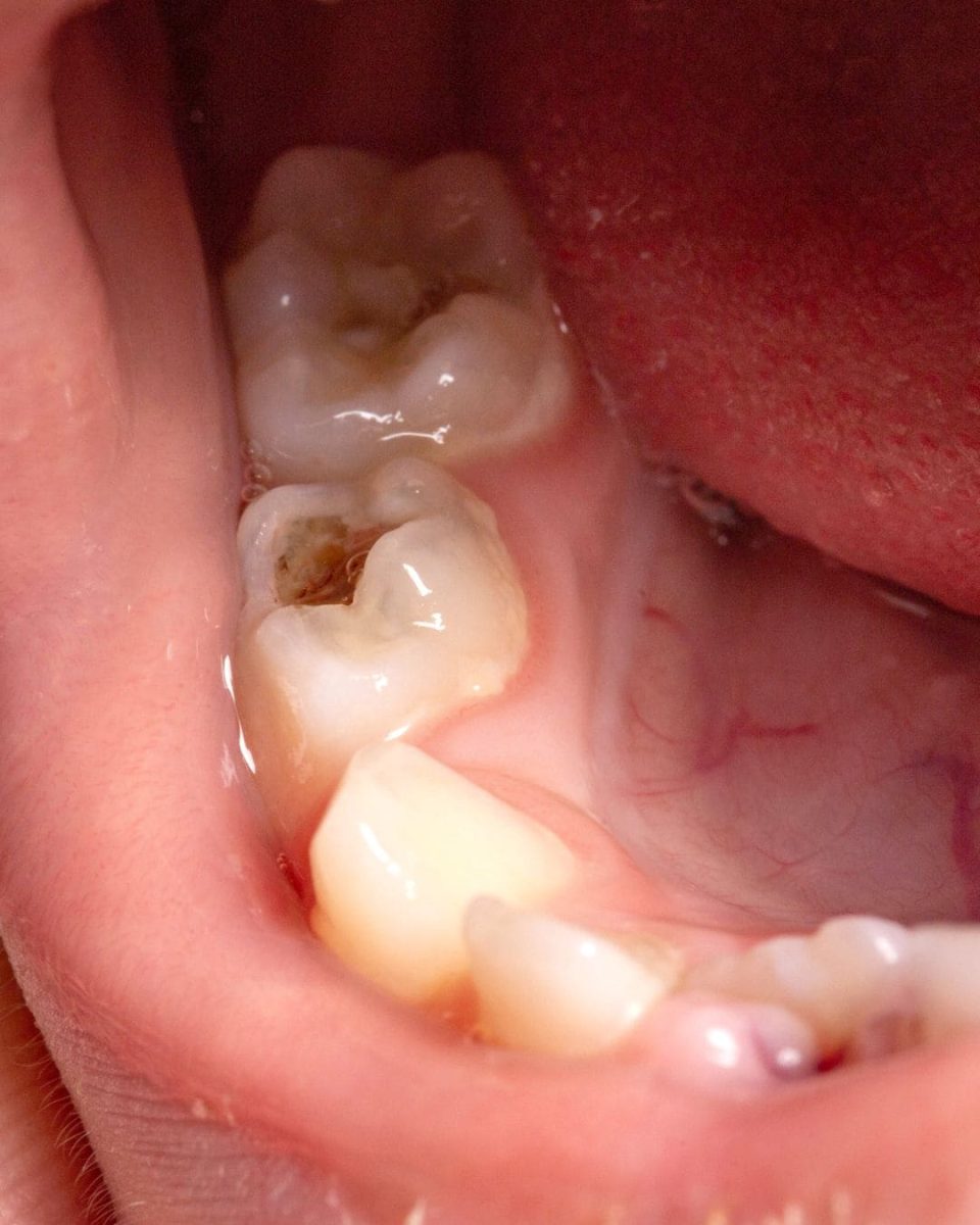 carie dentista sassari