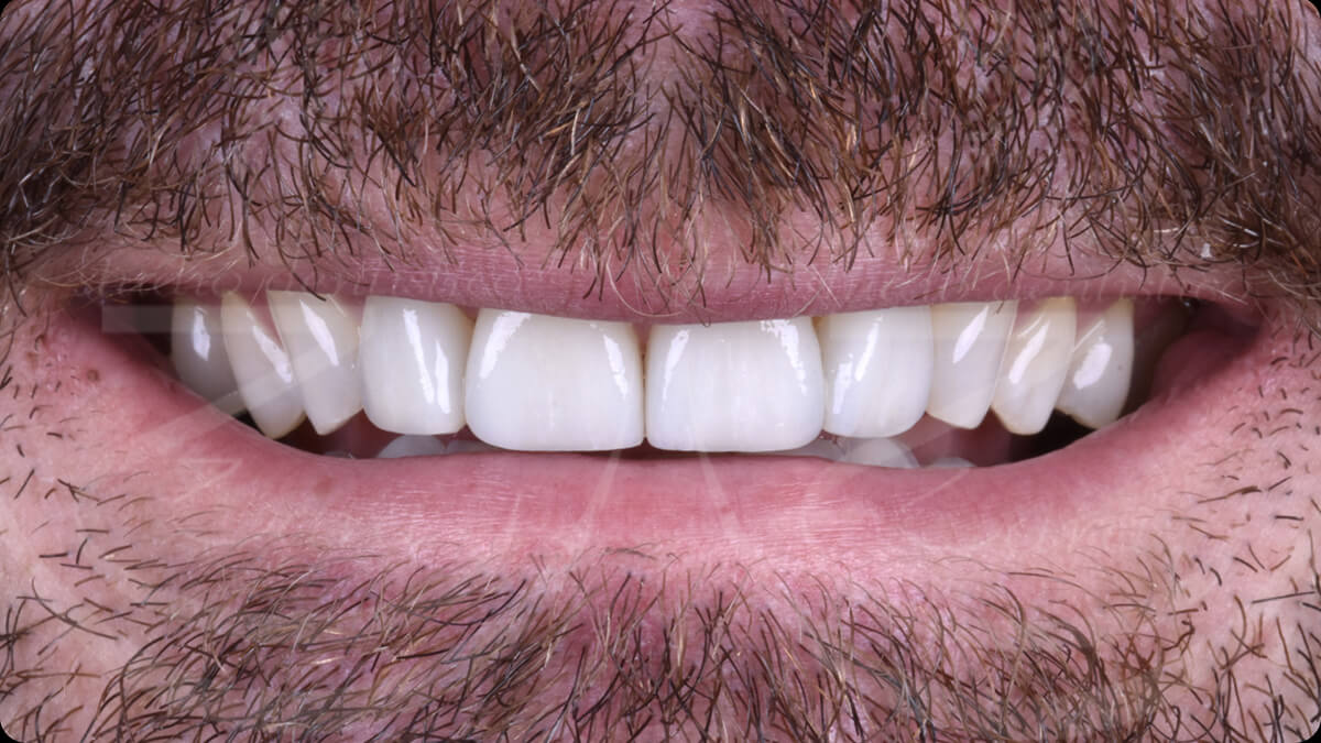 faccette-dentali---dopo
