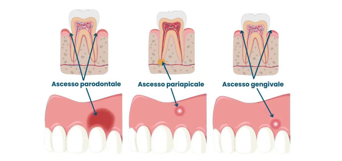 tipi di ascesso dentale