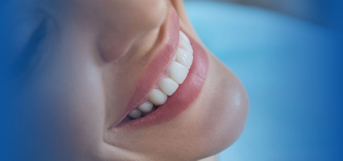 denti sbiancati