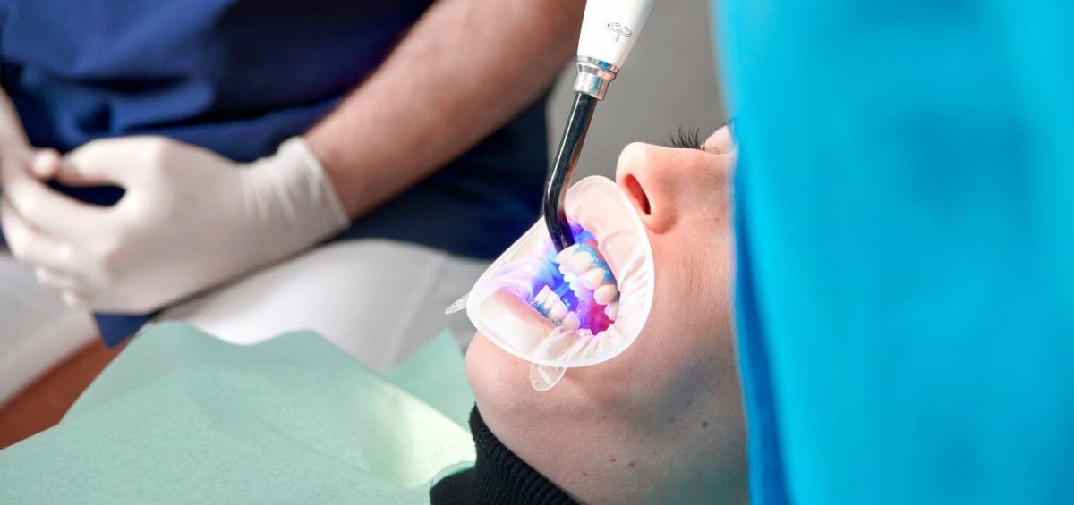Sbiancamento dentale professionale in studio