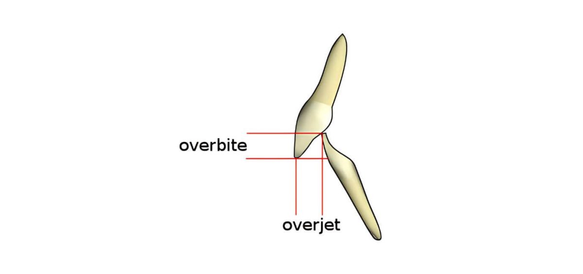 overbite e overjet