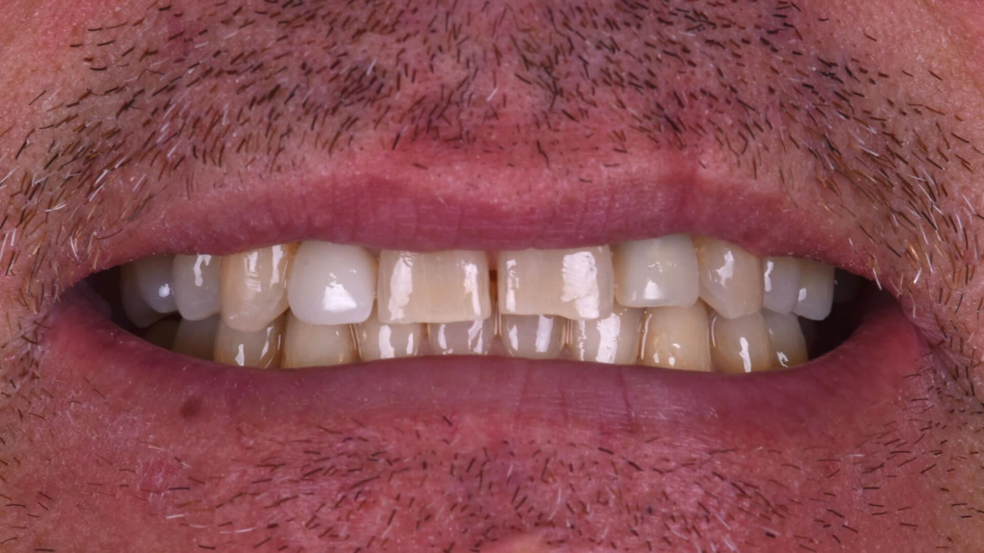 Studio odontoiatrico Zara - faccette dentali 02 prima