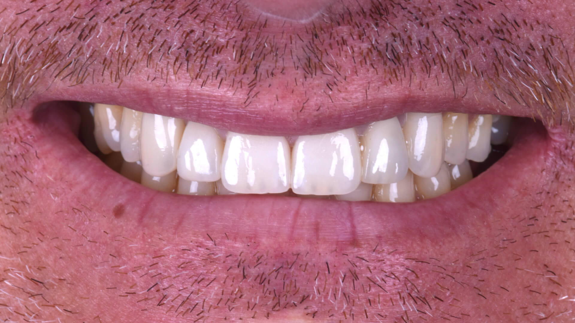Studio odontoiatrico Zara - faccette dentali 02 dopo