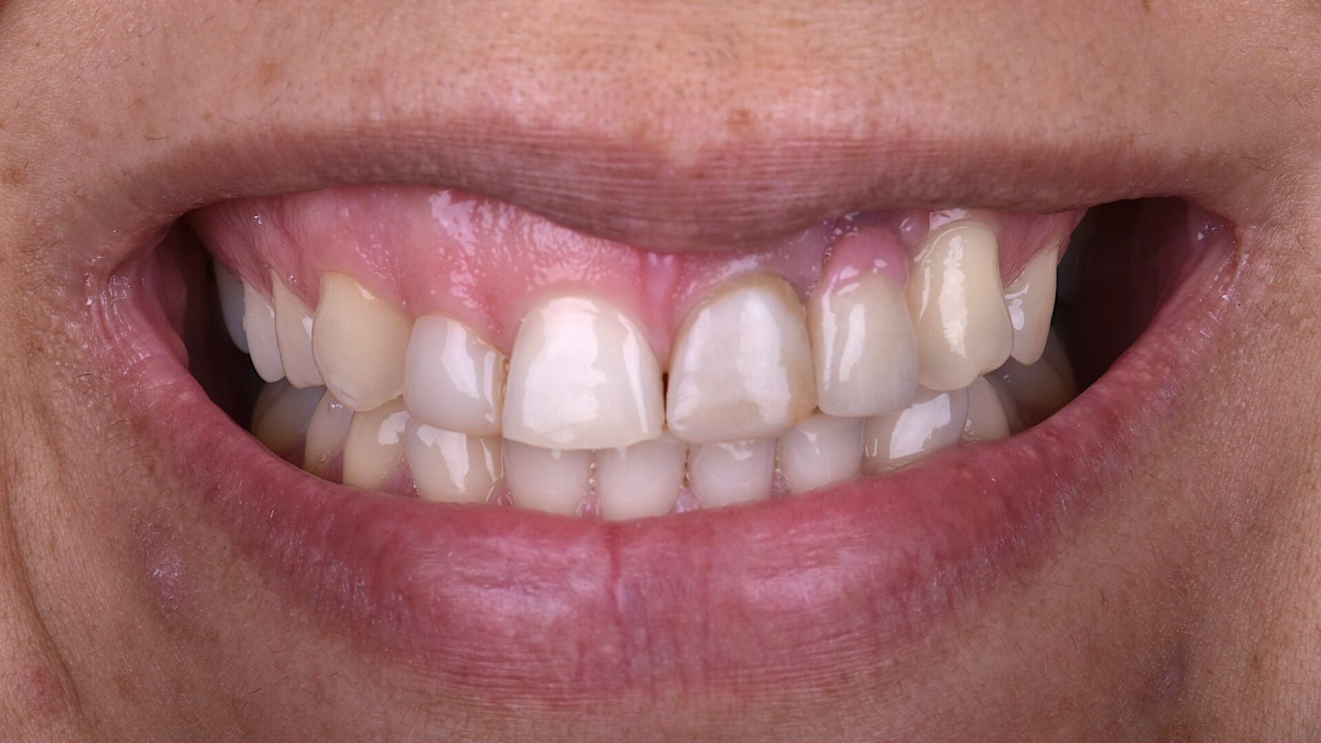 Studio odontoiatrico Zara - faccette dentali 03 prima