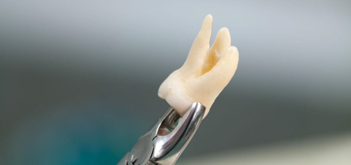 estrazione dente