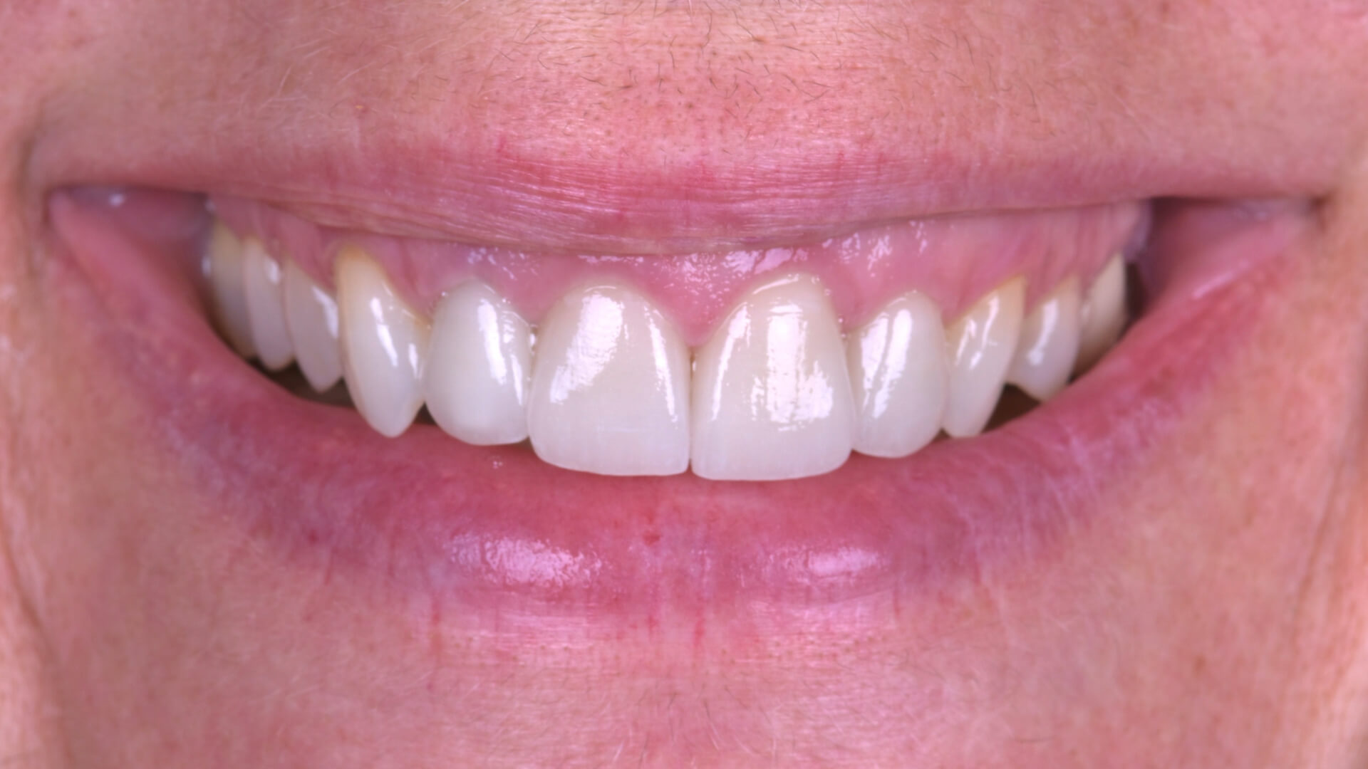 Studio odontoiatrico Zara - faccette dentali 01 dopo