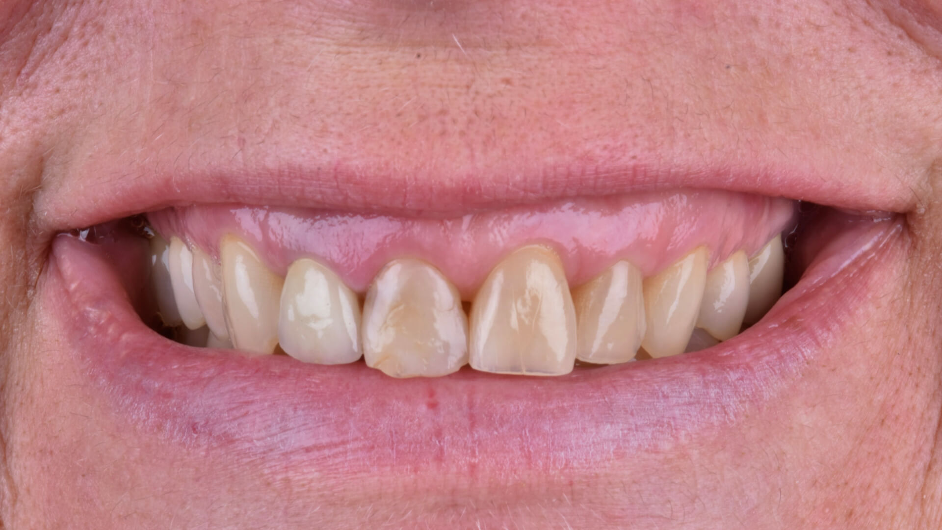 Studio odontoiatrico Zara - faccette dentali 01 prima