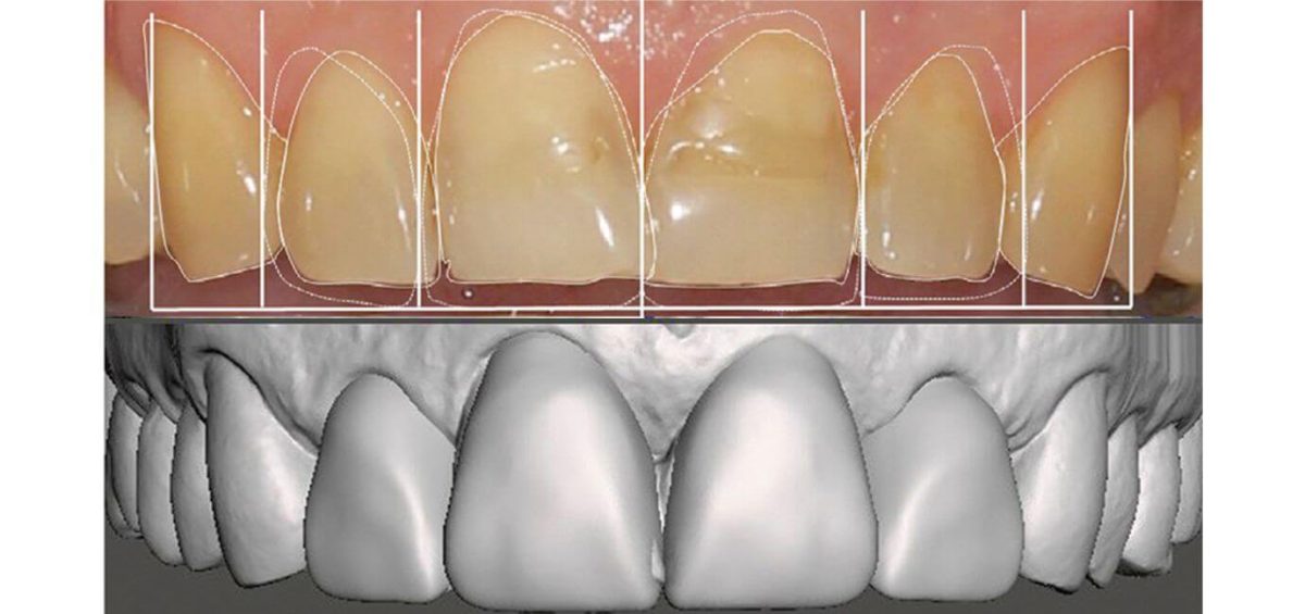 digital smile design Simulazione del nuovo sorriso