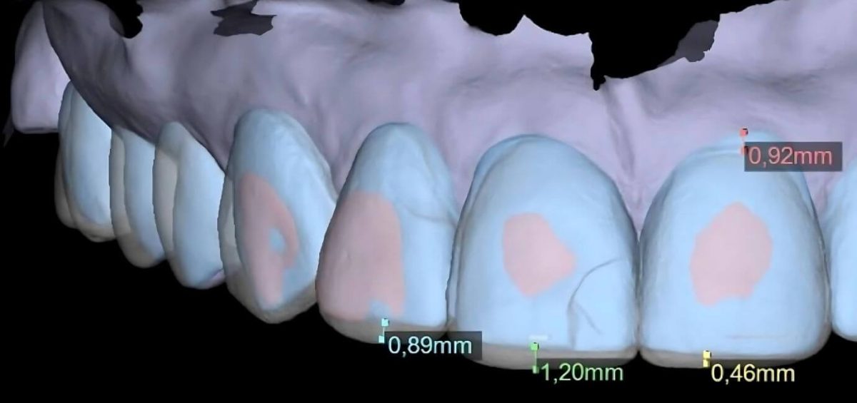 digital smile design analisi e progettazione