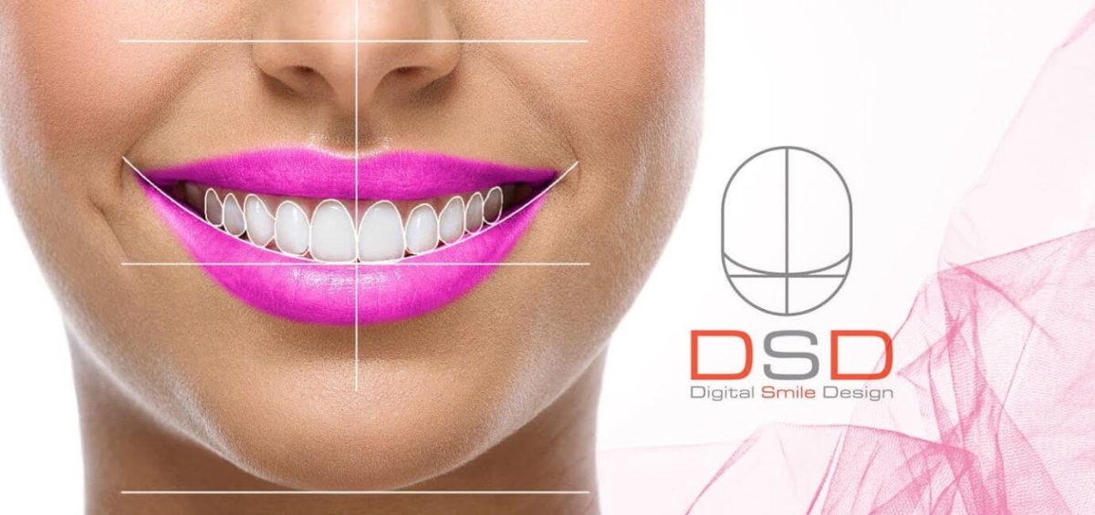 digital-smile-design-dsd