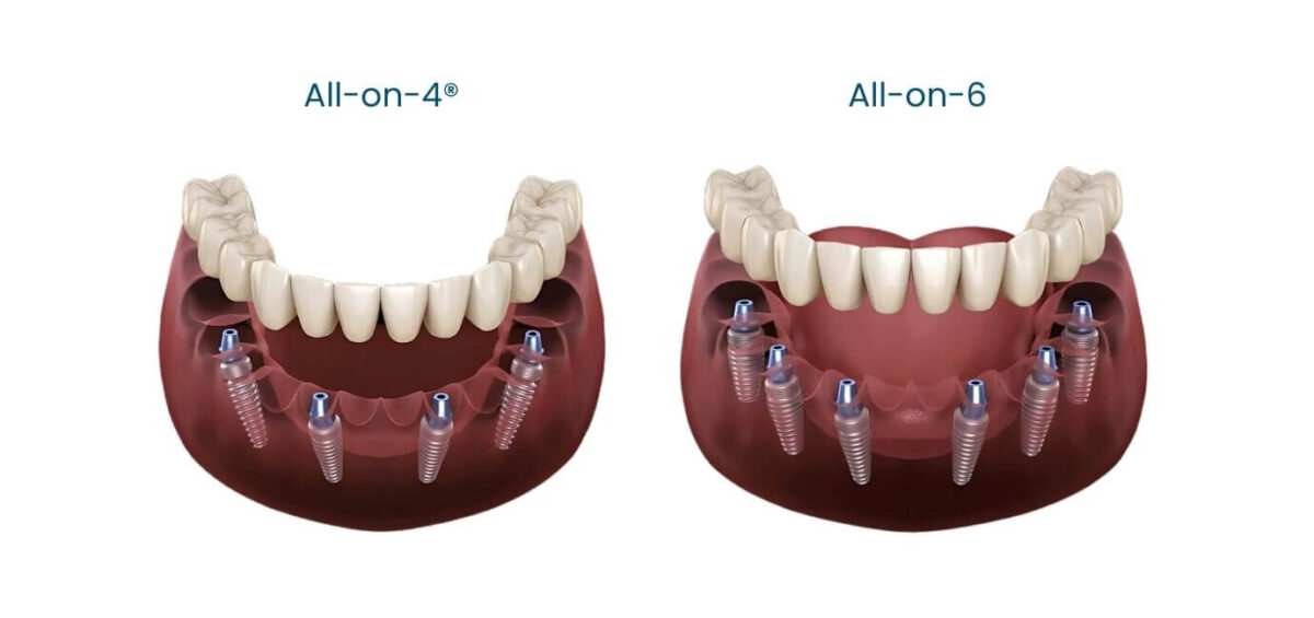 All-on-4 e All-on-6