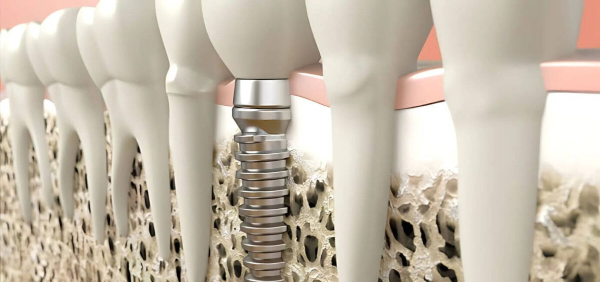 osseointegrazione impianti dentali