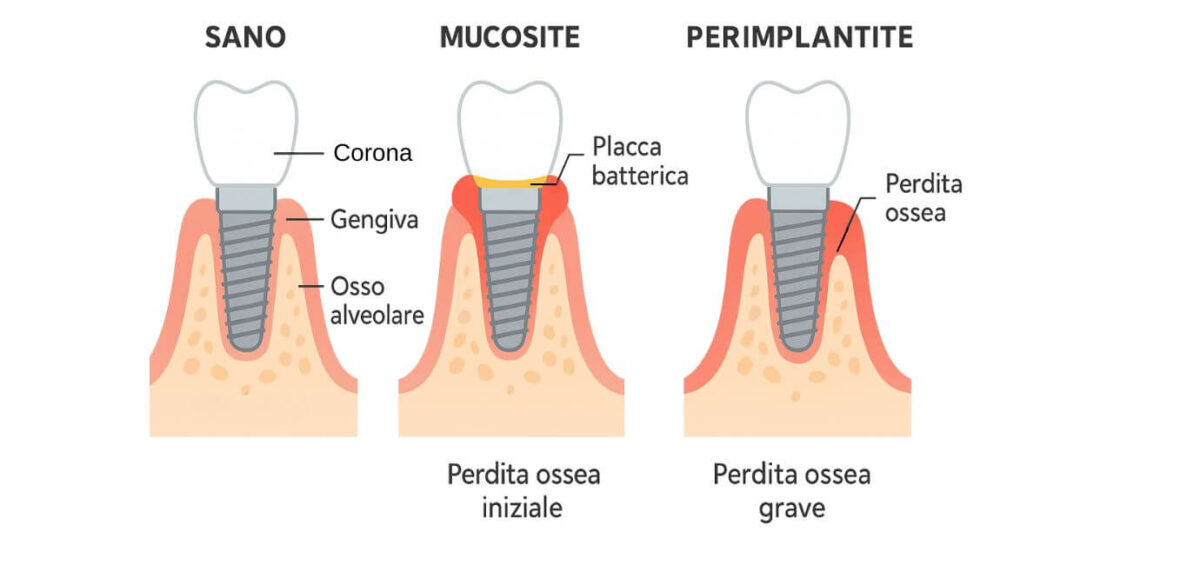 perimplatite e mucosite