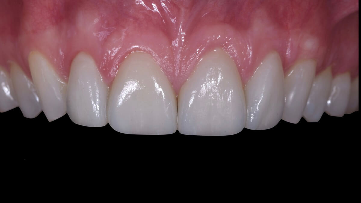 faccette senza toccare denti dopo002