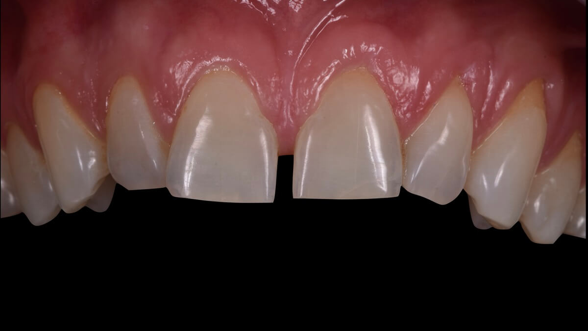 faccette senza toccare denti prima.001