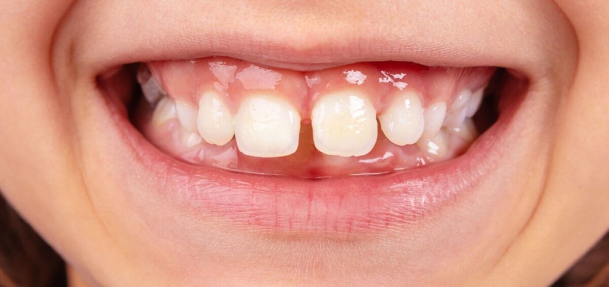 Diastema bambini