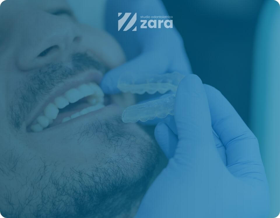 Apparecchio invisibile negli adulti: funziona davvero o &egrave; solo marketing?